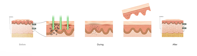 M&aacute;quina a laser para remo&ccedil;&atilde;o de tatuagem