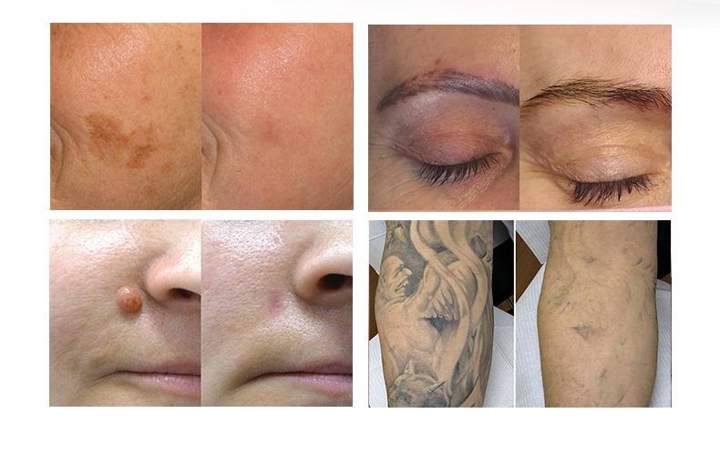 M&aacute;quina a laser para remo&ccedil;&atilde;o de tatuagem