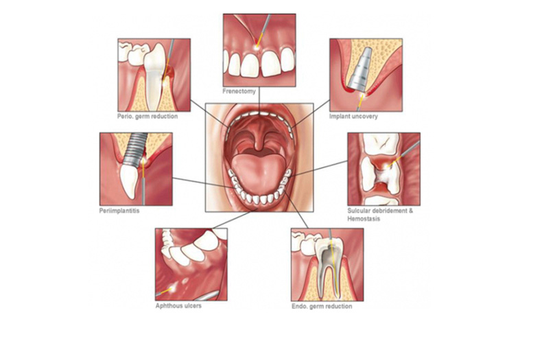 m&aacute;quina a laser odontol&oacute;gica